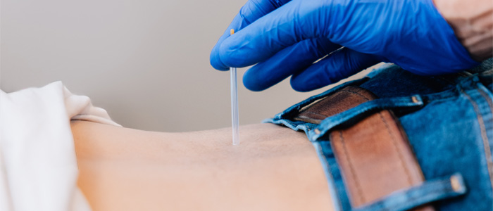 Chiropractic Belton TX Integrative Dry Needling