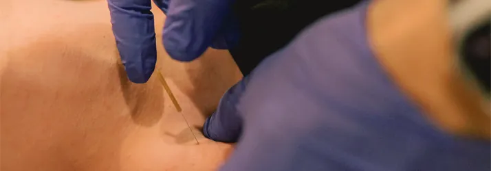 Chiropractic Belton TX Dry Needling Chiropractic Belton TX Dry Needling